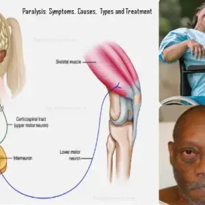 Paralysis Treatment Medicine | Symptoms, Causes, Types, Diagnosis and Prevention