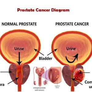 Prostate Cancer Treatment Medicine Supplements and Remedy in Ghana