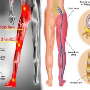 Sciatica Treatment Medicine and Supplements for Pain Relief