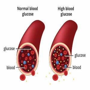 High Blood Sugar Treatment Medicine in Ghana | Natural Blood Glucose Control
