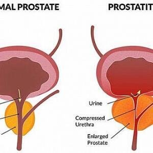 Prostate Infection Prostatitis Treatment Medicine in Ghana