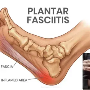 Plantar Fasciitis Treatment Medicine | Symptoms, Causes, Physiotherapy and Exercises