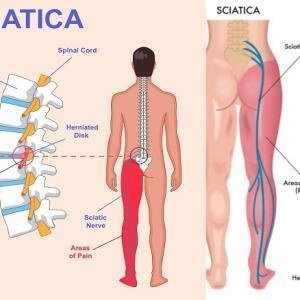 Sciatica Treatment Medicine | Causes, Symptoms, Diagnosis and Natural Relief