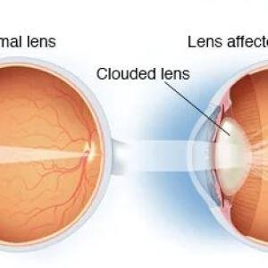 Glaucoma and Cataract Treatment Supplements in Ghana | Natural Eye Health Support