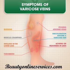 Varicose Veins Pain Relief and Treatment Medicine in Ghana