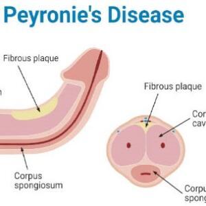 Peyronie's Disease Treatment Medicine | Causes, Symptoms and Diagnosis in Ghana
