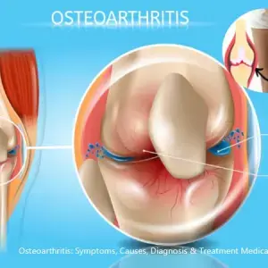 Osteoarthritis Treatment Medicine | Symptoms, Causes, Diagnosis and Relief