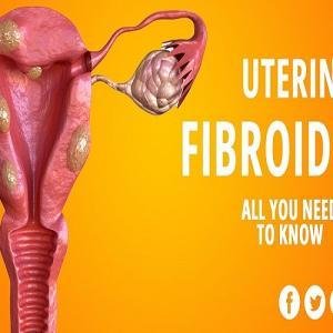 Fibroids Treatment Medicine Without Surgery in Ghana
