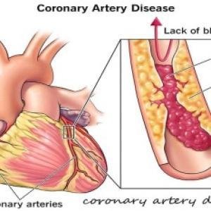 Coronary Artery Disease Treatment Medicine in Ghana | Natural Heart Artery Support