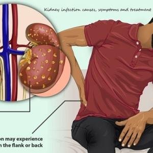 Kidney Infection Pyelonephritis Treatment Medicine in Ghana