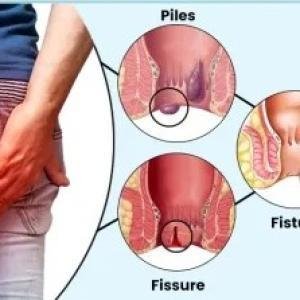 Piles Hemorrhoids Treatment Medicine in Ghana | Kooko Natural Relief