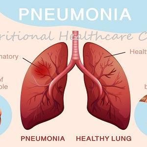 Pneumonia Treatment Medicine in Ghana | Natural Respiratory Infection Supplement